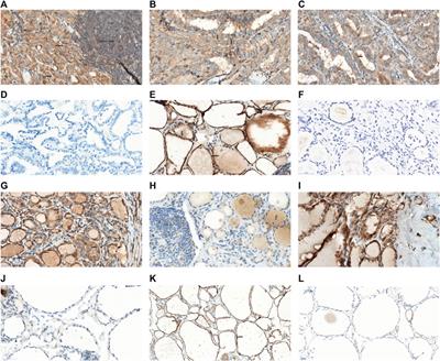Clinical Significance of PEAK1 Expression and BRAF V600E Mutation in Papillary Thyroid Cancer